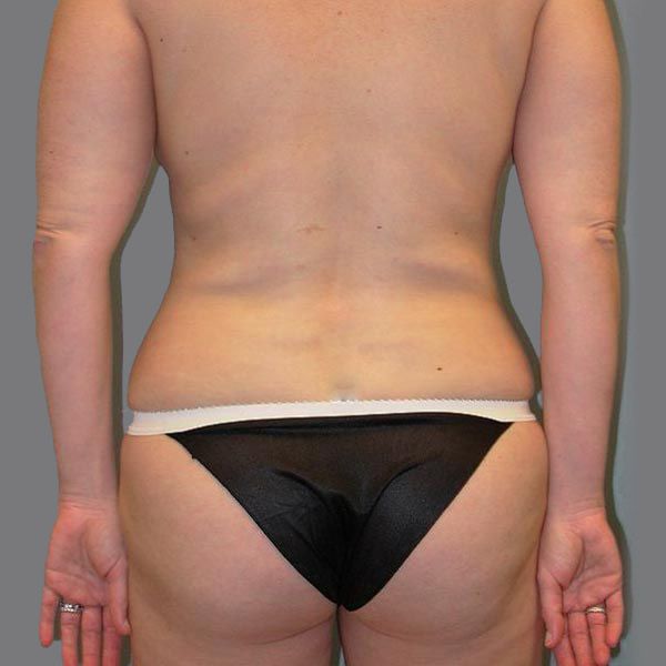 After liposuction